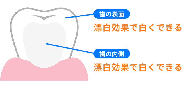 歯の表面は漂白効果で白くできる、歯の内側は漂白効果で白くできる
