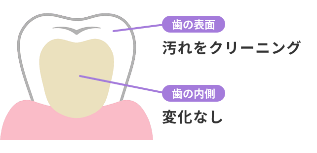 歯の表面は汚れをクリーニング、歯の内側は変化なし
